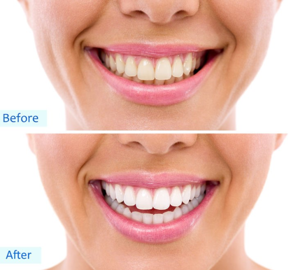 Teeth Whitening Corona, CA Green River Family Dentistry
